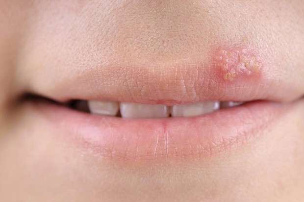 Zona thần kinh trên miệng: căn bệnh thường gặp khi trời hanh khô khiến không ít nàng cảm thấy ái ngại - Ảnh 1. Zona thần kinh trên miệng: căn bệnh thường gặp khi trời hanh khô khiến không ít nàng cảm thấy ái ngại - Ảnh 1.
