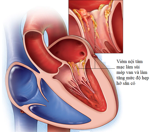 Bs bệnh viện Việt Đức cảnh báo: Khi bị sốt kéo dài, tái phát, rất có thể bạn mắc phải 1 bệnh lý nguy hiểm, không phát hiện kịp thời khó giữ được tính mạng - Ảnh 1. Bs bệnh viện Việt Đức cảnh báo: Khi bị sốt kéo dài, tái phát, rất có thể bạn mắc phải 1 bệnh lý nguy hiểm, không phát hiện kịp thời khó giữ được tính mạng - Ảnh 1.