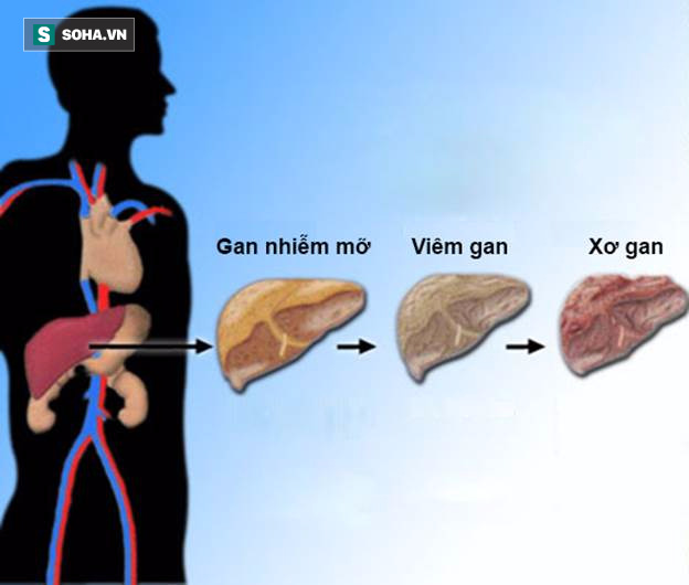 photo-0-1499822758706 Các giai đoạn phát triển của bệnh gan nhiễm mỡ.