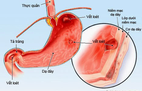 Dấu hiệu sớm của ung thư dạ dày: Nếu biết để phát hiện kịp thời, cơ hội khỏi bệnh rất cao - Ảnh 1. Dấu hiệu sớm của ung thư dạ dày: Nếu biết để phát hiện kịp thời, cơ hội khỏi bệnh rất cao - Ảnh 1.