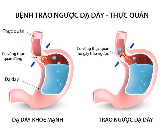 Trào ngược dạ dày: Bệnh của “thời đại mới”, tác nhân lớn nhất gây ung thư dạ dày và 7 điều buộc phải làm để không rơi vào cảnh bệnh tình - Ảnh 1. Trào ngược dạ dày: Bệnh của “thời đại mới”, tác nhân lớn nhất gây ung thư dạ dày và 7 điều buộc phải làm để không rơi vào cảnh bệnh tình - Ảnh 1.