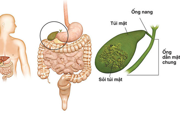 4 thói quen phổ biến có thể khiến bạn bị cắt bỏ túi mật: Ngăn ngừa sỏi và ung thư thế nào? - Ảnh 1. 4 thói quen phổ biến có thể khiến bạn bị cắt bỏ túi mật: Ngăn ngừa sỏi và ung thư thế nào? - Ảnh 1.