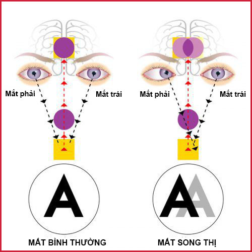 Nguyên nhân và hướng điều trị bệnh song thị, chứng nhìn một vật thành hai hình - Ảnh 1. Nguyên nhân và hướng điều trị bệnh song thị, chứng nhìn một vật thành hai hình - Ảnh 1.