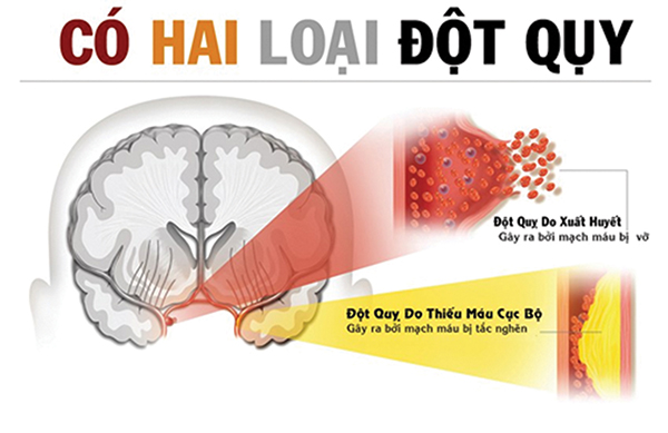 Cấp cứu đột quỵ: Sự sống tính trong từng phút giây - Ảnh 1. Cấp cứu đột quỵ: Sự sống tính trong từng phút giây - Ảnh 1.