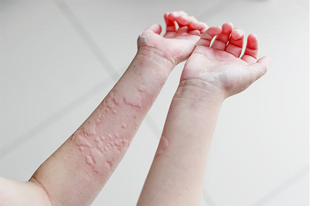 2 tình trạng dị ứng thường gặp khi trời chuyển lạnh và 7 việc cần làm để tránh gặp biến chứng nguy hiểm - Ảnh 1. 2 tình trạng dị ứng thường gặp khi trời chuyển lạnh và 7 việc cần làm để tránh gặp biến chứng nguy hiểm - Ảnh 1.