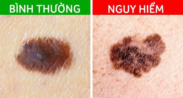 3 biểu hiện bất thường trên da tuyệt đối không được bỏ qua: Đốm và nốt ruồi tưởng như rất bình thường lại có thể là mầm mống của u ác tính - Ảnh 1. 3 biểu hiện bất thường trên da tuyệt đối không được bỏ qua: Đốm và nốt ruồi tưởng như rất bình thường lại có thể là mầm mống của u ác tính - Ảnh 1.