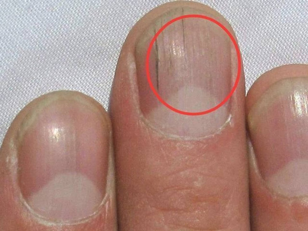 Móng tay xuất hiện các đường kẻ dọc bất thường, coi chừng là dấu hiệu của bệnh tật, bạn nên đi khám nhanh còn kịp - Ảnh 1. Móng tay xuất hiện các đường kẻ dọc bất thường, coi chừng là dấu hiệu của bệnh tật, bạn nên đi khám nhanh còn kịp - Ảnh 1.