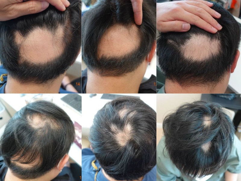 32 tuổi đã hói gần nửa đầu vì 2 thói quen phổ biến, bác sĩ chỉ ra 4 tăng 6 giảm trong thực phẩm để chống rụng tóc - Ảnh 1. 32 tuổi đã hói gần nửa đầu vì 2 thói quen phổ biến, bác sĩ chỉ ra 4 tăng 6 giảm trong thực phẩm để chống rụng tóc - Ảnh 1.