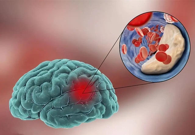 Nhồi máu não rất “sủng ái” 4 kiểu người này: Muốn não ưu ái chỉ cần duy trì 3 thói quen tốt, quái vật não cũng sợ hãi mà tránh xa - Ảnh 1. Nhồi máu não rất “sủng ái” 4 kiểu người này: Muốn não ưu ái chỉ cần duy trì 3 thói quen tốt, quái vật não cũng sợ hãi mà tránh xa - Ảnh 1.