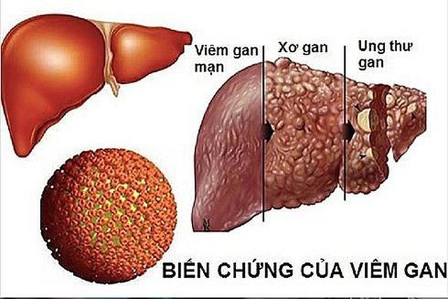 Ung thư biểu mô tế bào gan chiếm 80% các trường hợp, thường liên quan đến các tổn thương gan mạn tính: Bệnh tiến triển vô cùng nhanh, ai cũng phải hành động ngay điều này để giảm rủi ro chết người - Ảnh 1. Ung thư biểu mô tế bào gan chiếm 80% các trường hợp, thường liên quan đến các tổn thương gan mạn tính: Bệnh tiến triển vô cùng nhanh, ai cũng phải hành động ngay điều này để giảm rủi ro chết người - Ảnh 1.