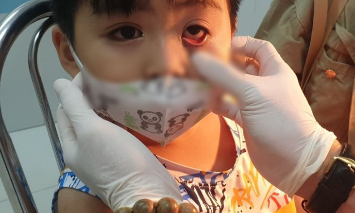 Trẻ mầm non đi học giữa mùa dịch đau mắt đỏ: Bác sĩ khuyên những việc cần làm để phòng bệnh - Ảnh 1. Trẻ mầm non đi học giữa mùa dịch đau mắt đỏ: Bác sĩ khuyên những việc cần làm để phòng bệnh - Ảnh 1.