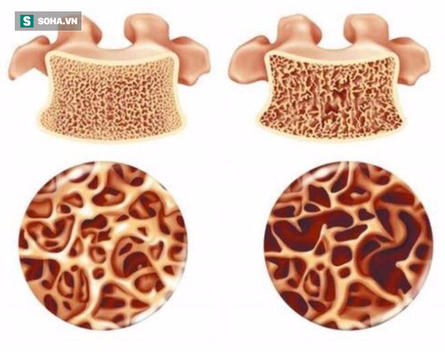 5 cách ăn uống hủy hoại xương nhanh chóng: Nếu kéo dài thì hậu quả sẽ rất nghiêm trọng - Ảnh 1. 5 cách ăn uống hủy hoại xương nhanh chóng: Nếu kéo dài thì hậu quả sẽ rất nghiêm trọng - Ảnh 1.
