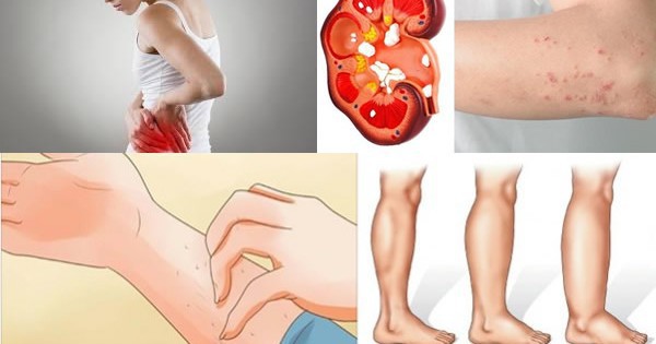 Tỉnh táo với 10 dấu hiệu không rõ ràng nhưng lại là tín hiệu cho thấy thận của bạn đang có vấn đề - Ảnh 1. Tỉnh táo với 10 dấu hiệu không rõ ràng nhưng lại là tín hiệu cho thấy thận của bạn đang có vấn đề - Ảnh 1.