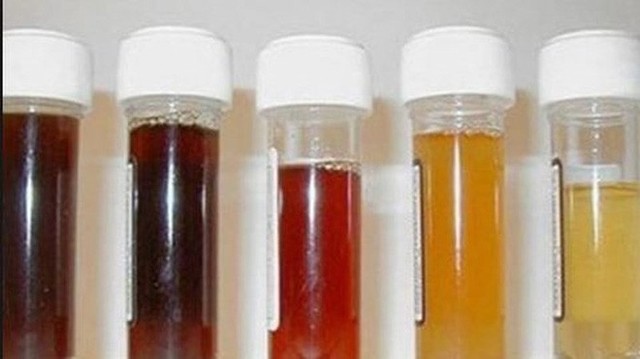 7 triệu chứng không đau có thể là dấu hiệu sớm của ung thư: Khám sớm có thể cứu sống bạn - Ảnh 1. 7 triệu chứng không đau có thể là dấu hiệu sớm của ung thư: Khám sớm có thể cứu sống bạn - Ảnh 1.