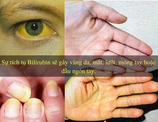 34 tuổi đã xơ gan giai đoạn cuối: Bác sĩ chỉ tận mặt thủ phạm gây ra 70% trường hợp xơ gan - Ảnh 1. 34 tuổi đã xơ gan giai đoạn cuối: Bác sĩ chỉ tận mặt thủ phạm gây ra 70% trường hợp xơ gan - Ảnh 1.