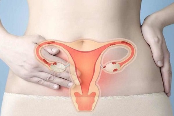 Ung thư cổ tử cung gây tử vong cao thứ 3 ở phụ nữ: Dấu hiệu cảnh báo, người có nguy cơ cao mắc phải và các giai đoạn phát triển bệnh - Ảnh 1. Ung thư cổ tử cung gây tử vong cao thứ 3 ở phụ nữ: Dấu hiệu cảnh báo, người có nguy cơ cao mắc phải và các giai đoạn phát triển bệnh - Ảnh 1.