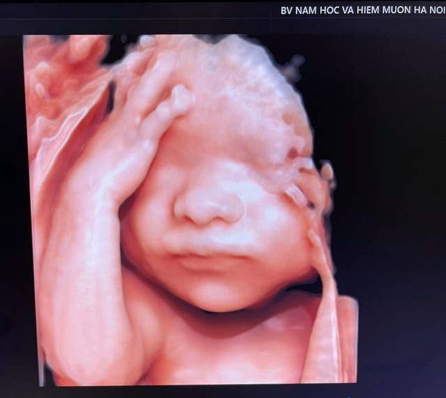 Siêu âm 5D giúp phát hiện và chẩn đoán sớm dị tật thai nhi - Ảnh 1. Siêu âm 5D giúp phát hiện và chẩn đoán sớm dị tật thai nhi - Ảnh 1.