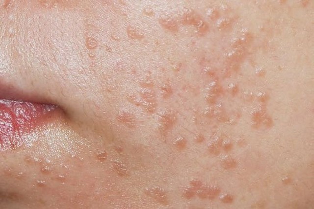 Bé gái 7 tuổi bị nhiễm virus HPV, cảnh báo về thói quen dùng chung đồ vật trong nhà - Ảnh 1. Bé gái 7 tuổi bị nhiễm virus HPV, cảnh báo về thói quen dùng chung đồ vật trong nhà - Ảnh 1.