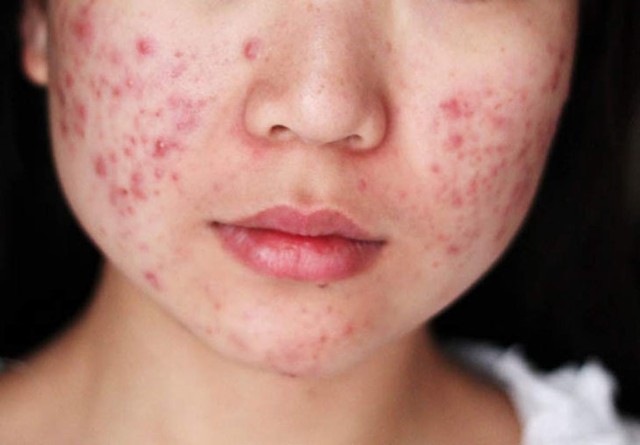 Người sắp bị ung thư gan thì trên mặt sẽ xuất hiện 3 biểu hiện bất thường, hãy đảm bảo 2 uống - 2 không ăn, lá gan sẽ cảm ơn bạn! - Ảnh 1. Người sắp bị ung thư gan thì trên mặt sẽ xuất hiện 3 biểu hiện bất thường, hãy đảm bảo 2 uống - 2 không ăn, lá gan sẽ cảm ơn bạn! - Ảnh 1.