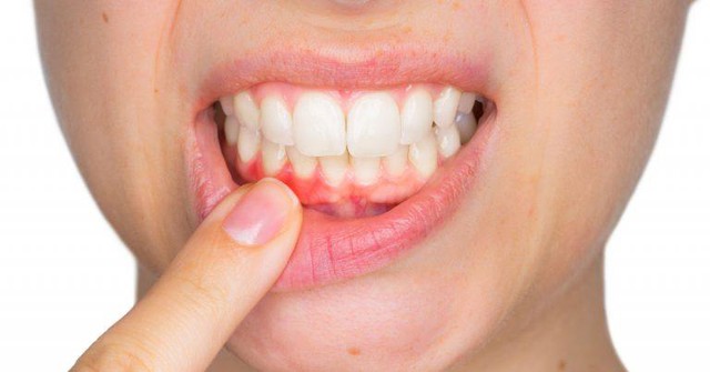 Đánh răng một ngày 2 lần, nhưng tỉ lệ sâu răng của người Việt Nam vẫn nằm ở top đầu? Vấn đề là do đâu? - Ảnh 1. Đánh răng một ngày 2 lần, nhưng tỉ lệ sâu răng của người Việt Nam vẫn nằm ở top đầu? Vấn đề là do đâu? - Ảnh 1.